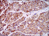 CCL2 / MCP1 Antibody - IHC of paraffin-embedded liver cancer tissues using CCL2 mouse monoclonal antibody with DAB staining.