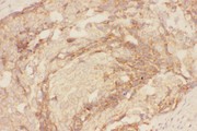 CCL26 / Eotaxin 3 Antibody - Eotaxin 3 antibody IHC-paraffin: Human Mammary Cancer Tissue.