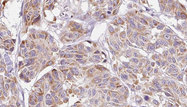 CCL4 / MIP-1 Beta Antibody - 1:100 staining human Melanoma tissue by IHC-P. The sample was formaldehyde fixed and a heat mediated antigen retrieval step in citrate buffer was performed. The sample was then blocked and incubated with the antibody for 1.5 hours at 22°C. An HRP conjugated goat anti-rabbit antibody was used as the secondary.