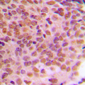 CCNB1 / Cyclin B1 Antibody - Immunohistochemical analysis of Cyclin B1 (pS126) staining in human breast cancer formalin fixed paraffin embedded tissue section. The section was pre-treated using heat mediated antigen retrieval with sodium citrate buffer (pH 6.0). The section was then incubated with the antibody at room temperature and detected using an HRP conjugated compact polymer system. DAB was used as the chromogen. The section was then counterstained with hematoxylin and mounted with DPX.