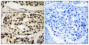 CCNC / Cyclin C Antibody - Immunohistochemistry analysis of paraffin-embedded human breast carcinoma, using Cyclin C (Phospho-Ser275) Antibody. The picture on the right is blocked with the phospho peptide.