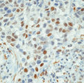 CCNE1 / Cyclin E1 Antibody - Formalin-fixed, paraffin-embedded human breast carcinoma stained with peroxidase-conjugate and DAB chromogen. Note nuclear staining of tumor cells.  This image was taken for the unmodified form of this product. Other forms have not been tested.