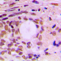 CCNF / Cyclin F Antibody - Immunohistochemical analysis of Cyclin F staining in human breast cancer formalin fixed paraffin embedded tissue section. The section was pre-treated using heat mediated antigen retrieval with sodium citrate buffer (pH 6.0). The section was then incubated with the antibody at room temperature and detected using an HRP conjugated compact polymer system. DAB was used as the chromogen. The section was then counterstained with hematoxylin and mounted with DPX.