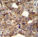CCNI2 Antibody - CCNI2 Antibody immunohistochemistry of formalin-fixed and paraffin-embedded human breast carcinoma followed by peroxidase-conjugated secondary antibody and DAB staining.