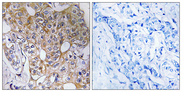 CCT6A Antibody - Immunohistochemistry analysis of paraffin-embedded human breast carcinoma tissue, using CCT6A Antibody. The picture on the right is blocked with the synthesized peptide.