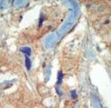 CD135 / FLT3 Antibody - Formalin-fixed and paraffin-embedded human cancer tissue reacted with the primary antibody, which was peroxidase-conjugated to the secondary antibody, followed by DAB staining. This data demonstrates the use of this antibody for immunohistochemistry; clinical relevance has not been evaluated. BC = breast carcinoma; HC = hepatocarcinoma.
