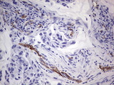 CD144 / CDH5 / VE Cadherin Antibody - IHC of paraffin-embedded Carcinoma of Human lung tissue using anti-CDH5 mouse monoclonal antibody. (Heat-induced epitope retrieval by 1 mM EDTA in 10mM Tris, pH8.5, 120°C for 3min).