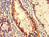 CD151 Antibody - Immunohistochemistry of paraffin-embedded human colon cancer using CD151 Antibody at dilution of 1:100
