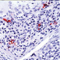 CD1A Antibody - Formalin-fixed, paraffin-embedded human tonsil stained with peroxidase-conjugate and AEC chromogen. Note membrane staining of interdigitating cells of stratified squamous epithelium of tonsil. This image was taken for the unmodified form of this product. Other forms have not been tested.