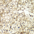CD1D Antibody - Immunohistochemistry of paraffin-embedded human kidney cancer using CD1D antibody at dilution of 1:200 (40x lens).