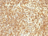 CD20 Antibody - IHC testing of CD20 antibody and human lymphoma tissue