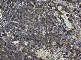 CD20 Antibody - IHC of paraffin-embedded Human lymphoma tissue using anti-MS4A1 mouse monoclonal antibody.