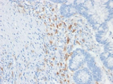 CD209 / DC-SIGN Antibody - IHC testing of FFPE human colon carcinoma with DC-SIGN antibody (clone C209/1781). Required HIER: boil tissue sections in 10mM Tris with 1mM EDTA, pH 9, for 10-20.