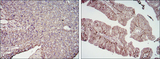 CD276 / B7-H3 Antibody - IHC of paraffin-embedded cervical cancer tissues (left) and ovarian cancer tissues (right) using CD276 mouse monoclonal antibody with DAB staining.