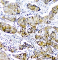 CD2AP Antibody - IHC analysis of CD2AP using anti-CD2AP antibody. CD2AP was detected in paraffin-embedded section of human mammary cancer. Heat mediated antigen retrieval was performed in citrate buffer (pH6, epitope retrieval solution) for 20 mins. The tissue section was blocked with 10% goat serum. The tissue section was then incubated with 1µg/ml mouse anti-CD2AP Antibody overnight at 4°C. Biotinylated goat anti-mouse IgG was used as secondary antibody and incubated for 30 minutes at 37°C. The tissue section was developed using Strepavidin-Biotin-Complex (SABC) with DAB as the chromogen.
