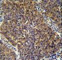 CD2BP2 Antibody - CD2BP2 antibody immunohistochemistry of formalin-fixed and paraffin-embedded human lung carcinoma followed by peroxidase-conjugated secondary antibody and DAB staining.