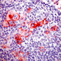 CD30 Antibody - Formalin-fixed paraffin-embedded Hodgkin's lymphoma stained with peroxidase conjugate and AEC chromogen. Note: Membrane and cytoplasmic staining.  This image was taken for the unmodified form of this product. Other forms have not been tested.