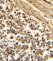 CD33 Antibody - Formalin-fixed and paraffin-embedded human lymph with CD33 (SIGLEC3) Antibody , which was peroxidase-conjugated to the secondary antibody, followed by DAB staining. This data demonstrates the use of this antibody for immunohistochemistry; clinical relevance has not been evaluated.