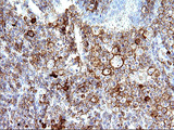 CD33 Antibody - IHC of paraffin-embedded Human lymphoma tissue using anti-CD33 mouse monoclonal antibody. (Heat-induced epitope retrieval by 10mM citric buffer, pH6.0, 120°C for 3min).