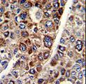 CD38 Antibody - Formalin-fixed and paraffin-embedded human hepatocarcinoma with CD38 Antibody , which was peroxidase-conjugated to the secondary antibody, followed by DAB staining. This data demonstrates the use of this antibody for immunohistochemistry; clinical relevance has not been evaluated.