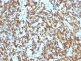 CD45RO Antibody - IHC testing of anti-CD45RO antibody and FFPE human lymphoma.  This image was taken for the unmodified form of this product. Other forms have not been tested.