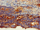 CD66c / CEACAM6 Antibody - Immunohistochemistry of paraffin-embedded human colon cancer at dilution of 1:100