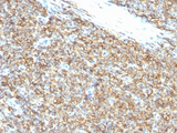 CD99 Antibody - Formalin-fixed, paraffin-embedded human Ewing's sarcoma stained with CD99 antibody (12E7).
