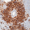 CD99 Antibody - Formalin-fixed, paraffin-embedded human Ewing's sarcoma stained with peroxidase-conjugate and DAB chromogen. Note cell membrane staining of tumor cells. This image was taken for the unmodified form of this product. Other forms have not been tested.