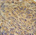 CD99L2 Antibody - CD99L2 Antibody immunohistochemistry of formalin-fixed and paraffin-embedded human lung carcinoma followed by peroxidase-conjugated secondary antibody and DAB staining.