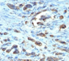 CDC20 Antibody - IHC testing of FFPE gastric carcinoma with Cdc20 antibody (clone AR12)