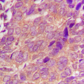 CDC25A Antibody - Immunohistochemical analysis of CDC25A staining in human breast cancer formalin fixed paraffin embedded tissue section. The section was pre-treated using heat mediated antigen retrieval with sodium citrate buffer (pH 6.0). The section was then incubated with the antibody at room temperature and detected using an HRP conjugated compact polymer system. DAB was used as the chromogen. The section was then counterstained with hematoxylin and mounted with DPX. w