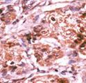 CDC25A Antibody - Formalin-fixed and paraffin-embedded human cancer tissue reacted with the primary antibody, which was peroxidase-conjugated to the secondary antibody, followed by AEC staining. This data demonstrates the use of this antibody for immunohistochemistry; clinical relevance has not been evaluated. BC = breast carcinoma; HC = hepatocarcinoma.