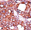 CDC25A Antibody - Formalin-fixed and paraffin-embedded human cancer tissue reacted with the primary antibody, which was peroxidase-conjugated to the secondary antibody, followed by AEC staining. This data demonstrates the use of this antibody for immunohistochemistry; clinical relevance has not been evaluated. BC = breast carcinoma; HC = hepatocarcinoma.