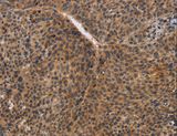 CDC34 Antibody - Immunohistochemistry of paraffin-embedded Human liver cancer using CDC34 Polyclonal Antibody at dilution of 1:50.