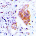 CDC37 Antibody - Immunohistochemical analysis of CDC37 (pS13) staining in human lung cancer formalin fixed paraffin embedded tissue section. The section was pre-treated using heat mediated antigen retrieval with sodium citrate buffer (pH 6.0). The section was then incubated with the antibody at room temperature and detected using an HRP polymer system. DAB was used as the chromogen. The section was then counterstained with hematoxylin and mounted with DPX.