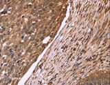 CDC37L1 Antibody - Immunohistochemistry of paraffin-embedded Human cervical cancer using CDC37L1 Polyclonal Antibody at dilution of 1:50.