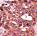 CDC6 Antibody - Formalin-fixed and paraffin-embedded human cancer tissue reacted with the primary antibody, which was peroxidase-conjugated to the secondary antibody, followed by AEC staining. This data demonstrates the use of this antibody for immunohistochemistry; clinical relevance has not been evaluated. BC = breast carcinoma; HC = hepatocarcinoma.