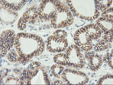 CDH2 / N Cadherin Antibody - IHC of paraffin-embedded Carcinoma of Human thyroid tissue using anti-CDH2 mouse monoclonal antibody.