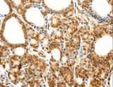 CDH23 / Cadherin 23 Antibody - Immunohistochemistry of paraffin-embedded Human thyroid cancer using CDH23 Polyclonal Antibody at dilution of 1:80.