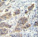CDH24 / EY Cadherin Antibody - CDH24 Antibody immunohistochemistry of formalin-fixed and paraffin-embedded human bladder carcinoma followed by peroxidase-conjugated secondary antibody and DAB staining.