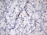 CDH4 / R Cadherin Antibody - IHC of paraffin-embedded Carcinoma of Human thyroid tissue using anti-CDH4 mouse monoclonal antibody. (Heat-induced epitope retrieval by 1 mM EDTA in 10mM Tris, pH8.5, 120°C for 3min).
