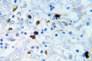 CDK1 / CDC2 Antibody - IHC of p-CDC2 (Y15) pAb in paraffin-embedded human breast carcinoma tissue.