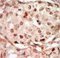 CDK10 Antibody - Formalin-fixed and paraffin-embedded human cancer tissue reacted with the primary antibody, which was peroxidase-conjugated to the secondary antibody, followed by DAB staining. This data demonstrates the use of this antibody for immunohistochemistry; clinical relevance has not been evaluated. BC = breast carcinoma; HC = hepatocarcinoma.