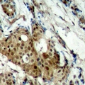CDK11B / CDC2L1 Antibody - Immunohistochemical analysis of CDK11B staining in human breast cancer formalin fixed paraffin embedded tissue section. The section was pre-treated using heat mediated antigen retrieval with sodium citrate buffer (pH 6.0). The section was then incubated with the antibody at room temperature and detected with HRP and DAB as chromogen. The section was then counterstained with hematoxylin and mounted with DPX.