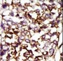 CDK4 Antibody - Formalin-fixed and paraffin-embedded human cancer tissue reacted with the primary antibody, which was peroxidase-conjugated to the secondary antibody, followed by AEC staining. This data demonstrates the use of this antibody for immunohistochemistry; clinical relevance has not been evaluated. BC = breast carcinoma; HC = hepatocarcinoma.