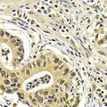 CDK7 Antibody - Immunohistochemistry of paraffin-embedded human gastric cancer using CDK7 antibodyat dilution of 1:200 (40x lens).