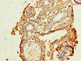 CDK7 Antibody - Immunohistochemistry of paraffin-embedded human breast cancer at dilution of 1:100