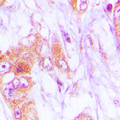 CDKL4 Antibody - Immunohistochemical analysis of CDKL4 staining in human lung cancer formalin fixed paraffin embedded tissue section. The section was pre-treated using heat mediated antigen retrieval with sodium citrate buffer (pH 6.0). The section was then incubated with the antibody at room temperature and detected using an HRP conjugated compact polymer system. DAB was used as the chromogen. The section was then counterstained with hematoxylin and mounted with DPX.