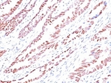 CDKN1C / p57 Kip2 Antibody - Formalin-fixed, paraffin-embedded human colon carcinoma stained with p57 antibody (KP10).  This image was taken for the unmodified form of this product. Other forms have not been tested.