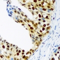 CDKN1C / p57 Kip2 Antibody - Immunohistochemical analysis of p57 Kip2 (pT310) staining in human prostate cancer formalin fixed paraffin embedded tissue section. The section was pre-treated using heat mediated antigen retrieval with sodium citrate buffer (pH 6.0). The section was then incubated with the antibody at room temperature and detected using an HRP conjugated compact polymer system. DAB was used as the chromogen. The section was then counterstained with haematoxylin and mounted with DPX.